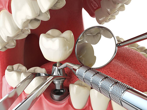 Best Emergency Wisdom Tooth Extraction in Redan, GA